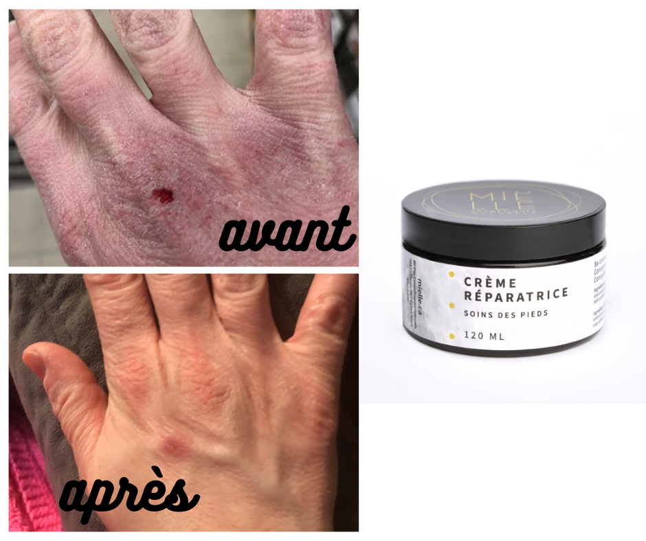 Au secours, mes mains sont sèches!