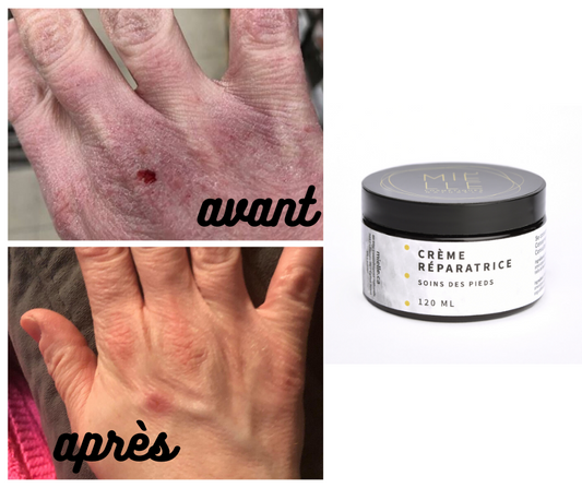 Au secours, mes mains sont sèches!